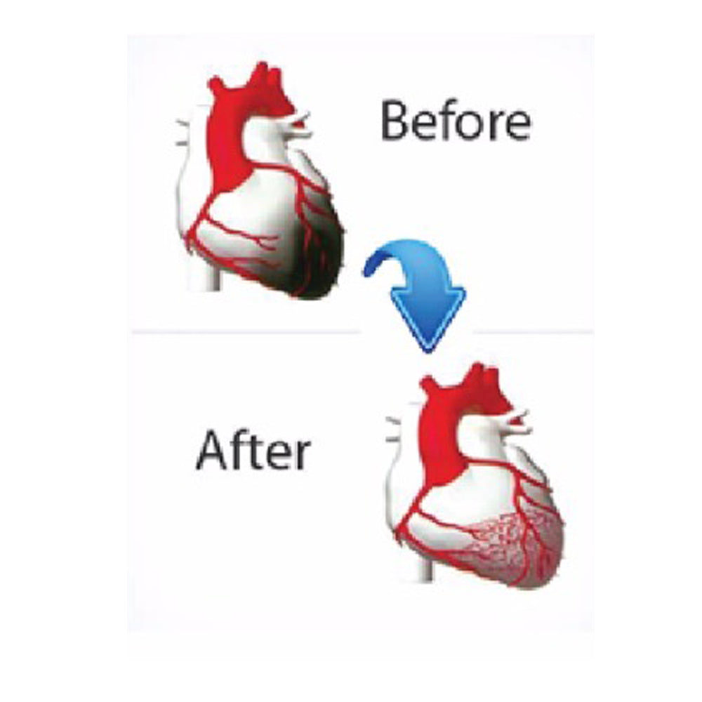 Merlin Renew ECP Machine for External Counterpulsation (ECP) Therapy